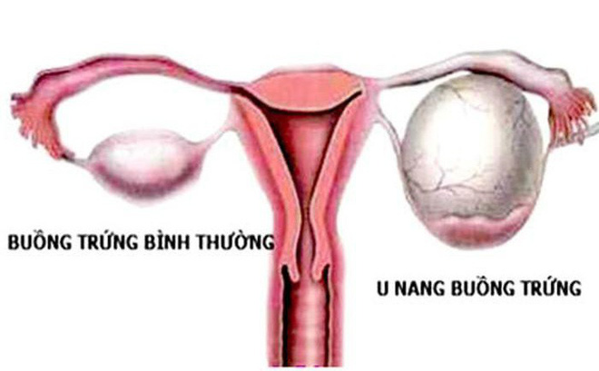U nang - Hình ảnh minh họa